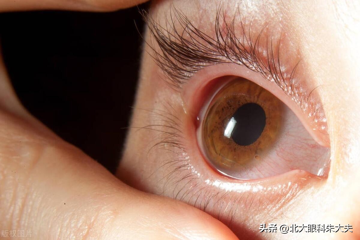 眼内进入异物该如何处理？