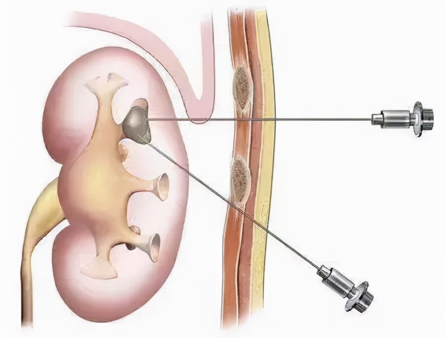 肾结石不疼不代表没有危害，一旦发现要及时就诊！