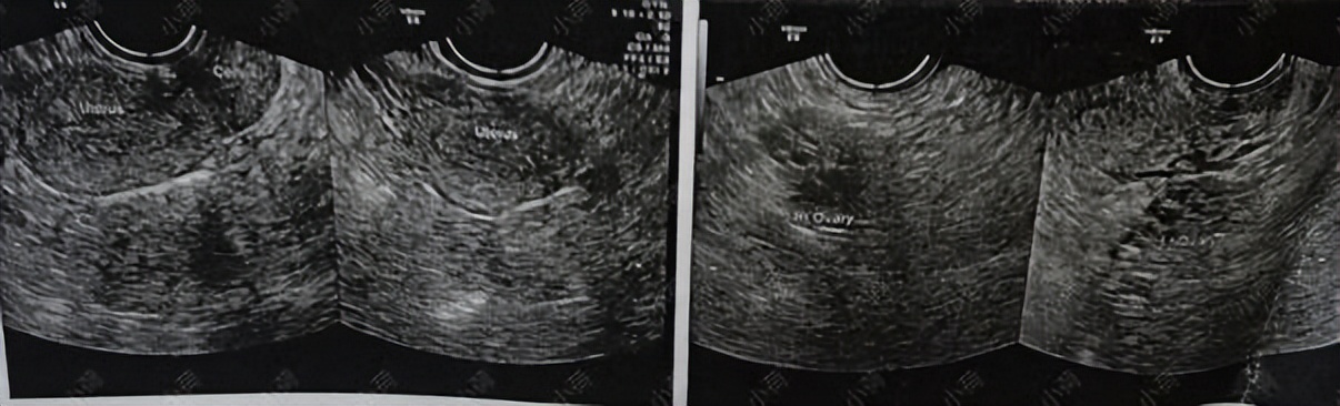 多囊卵巢综合症症状会引发长痘吗,多囊卵巢综合症长痘中成药