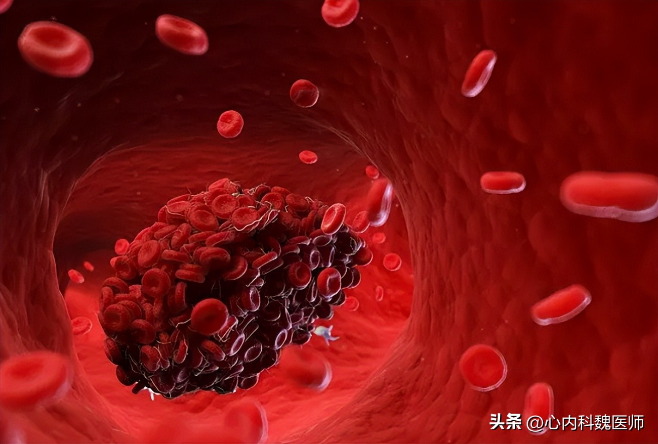 老年人房颤引起中风严重吗,缺血性中风和房颤中风区别