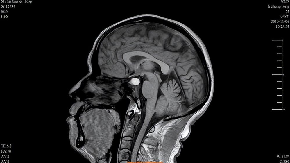 闭经指的是多长时间不来月经,月经一直正常突然闭经是什么原因