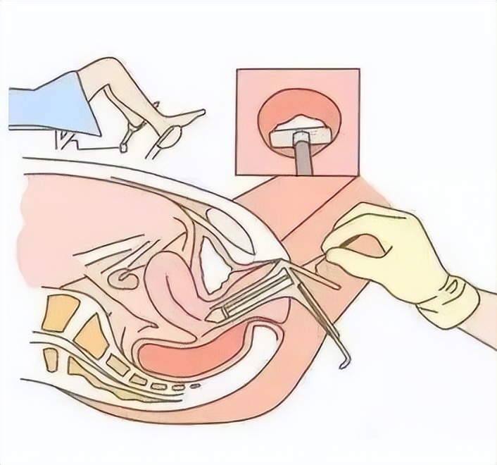 女性查hpv做哪些检查,男性hpv检查二甲医院可以查吗
