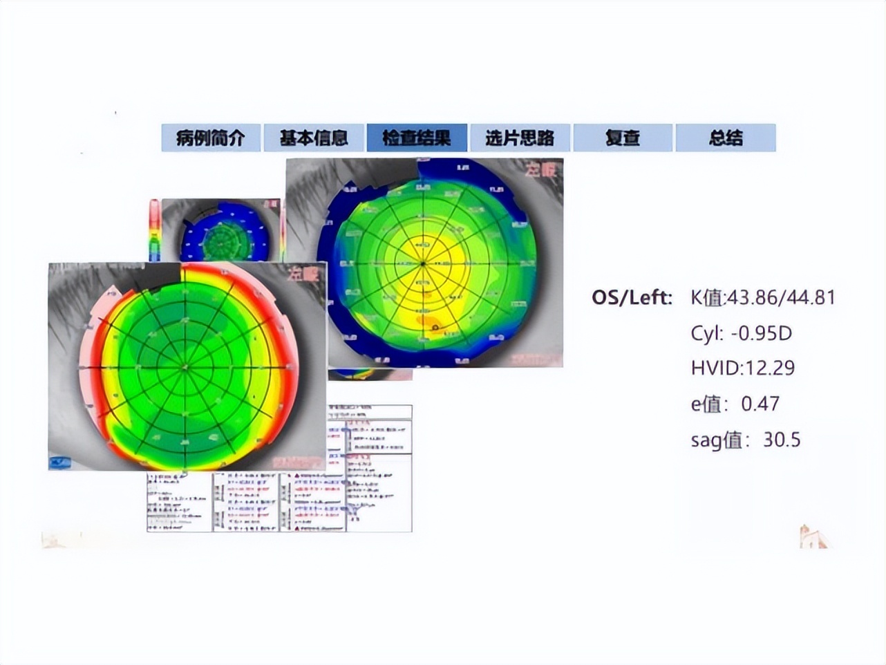 王凯角膜塑形镜原理,王凯医生塑形镜