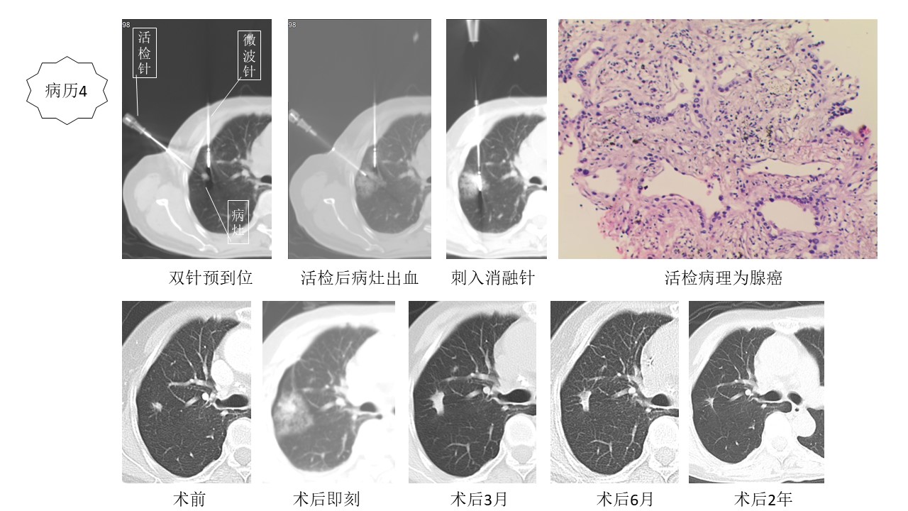 肿瘤局部消融的病历举例