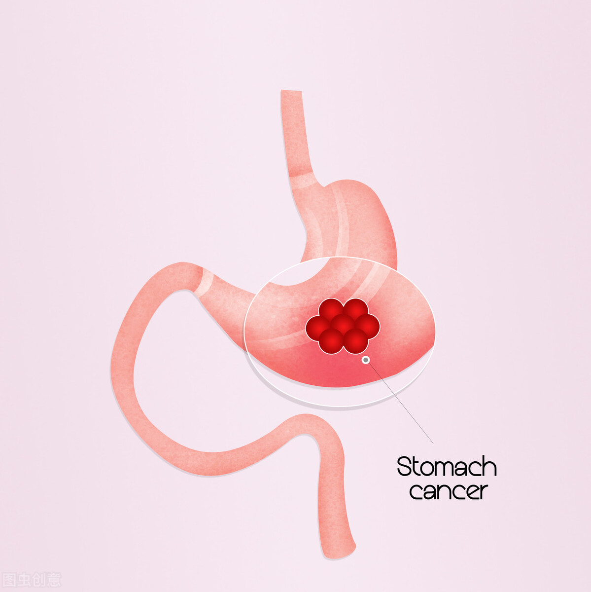 胃溃疡可以吃治幽门螺杆菌的药吗,抗幽门螺杆菌的中药