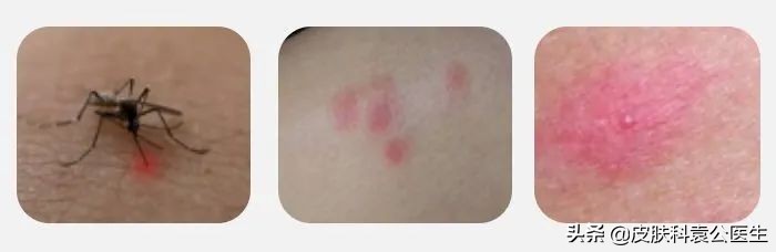 蚊虫叮咬引起的皮炎一年了没好,夏季有哪些虫叮咬会红肿
