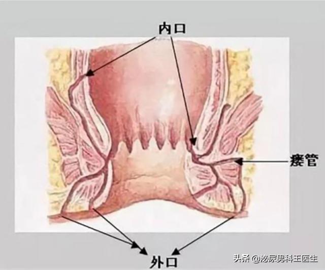 肛瘘不治是不是头疼,为什么肛瘘手术后才是痛苦的开始