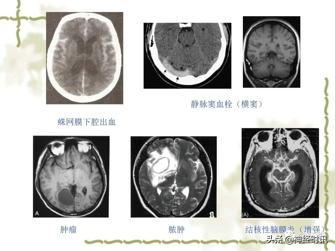头痛从前额到头顶,头痛从左脑到右脑