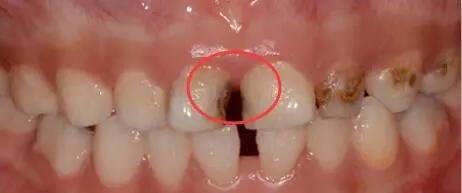 邻面龋为什么医生只补了一颗,邻面浅龋为什么医生不建议补牙