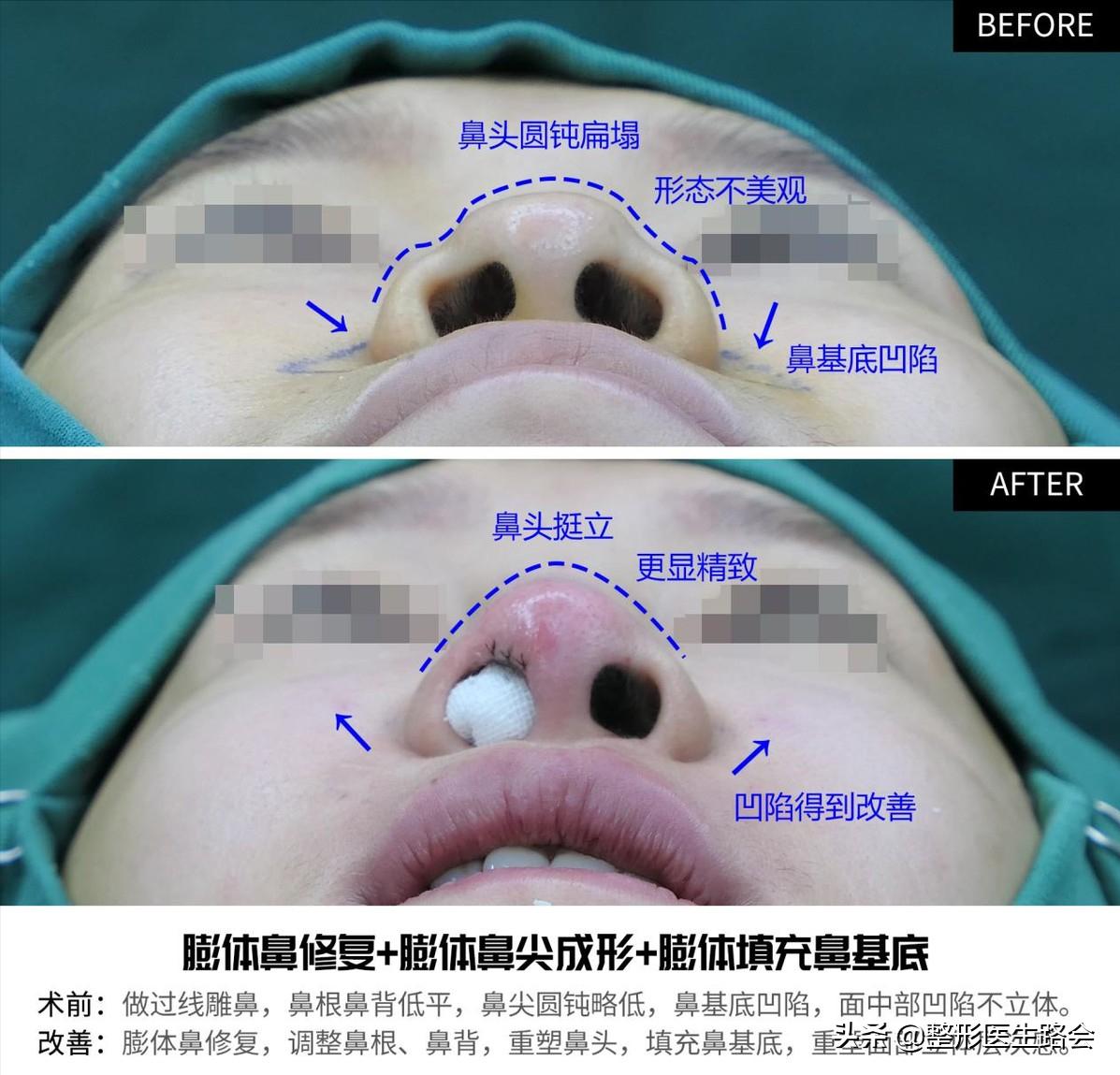 隆鼻三年后可以蹦极嘛,做了隆鼻到底可以蹦极吗