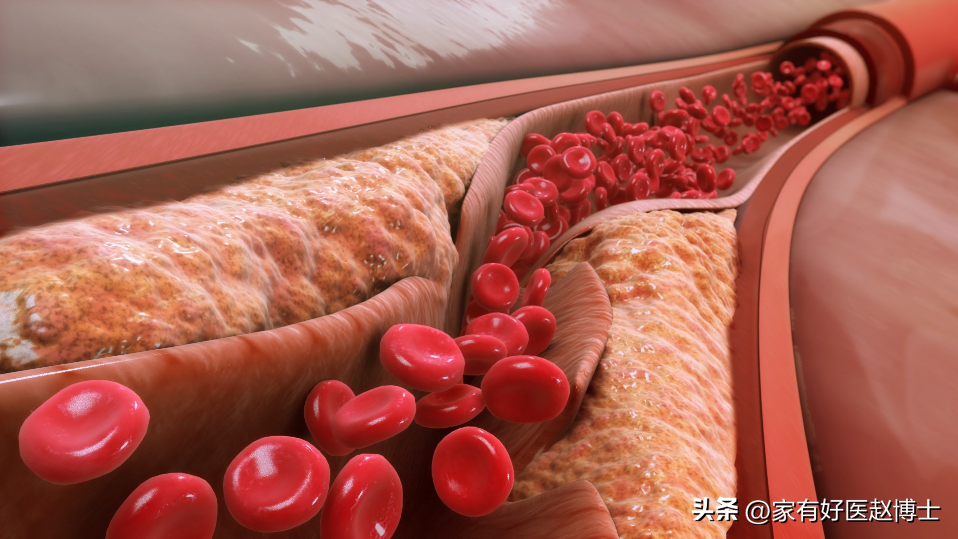 放了心脏支架如果支架坏了咋办,放了心脏支架为什么要抗凝血