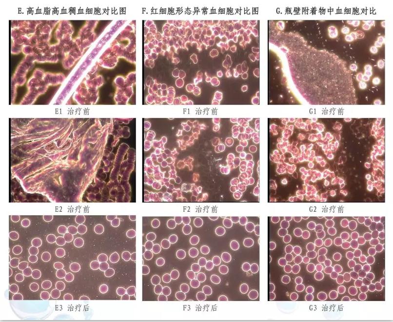 臭氧脑梗,烟酒都戒了还有什么戒不了