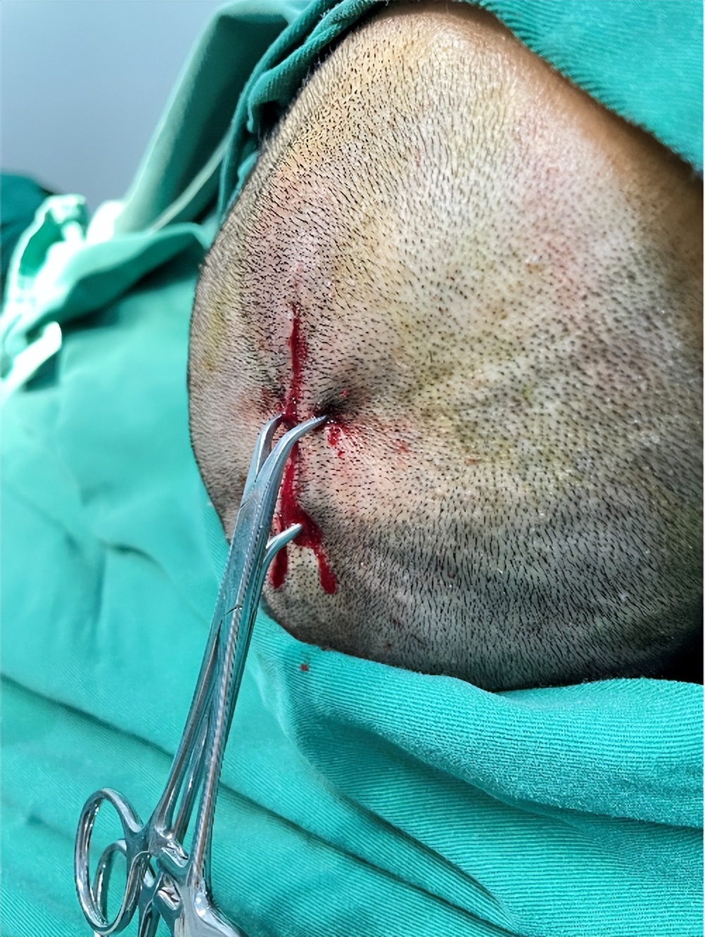 头上长了红色斑要注意了,头上有斑块怎么治