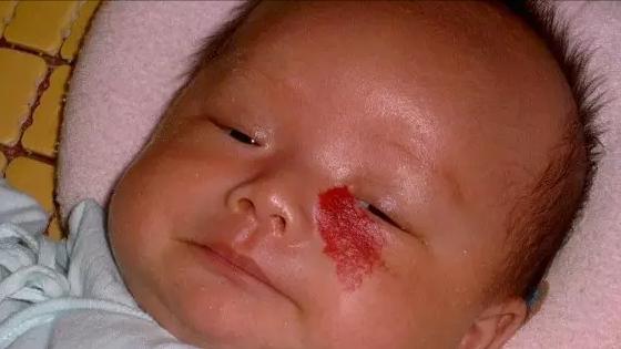 小孩身上的红痣可能是血管瘤,幼儿身上小红点富贵痣竟是血管瘤