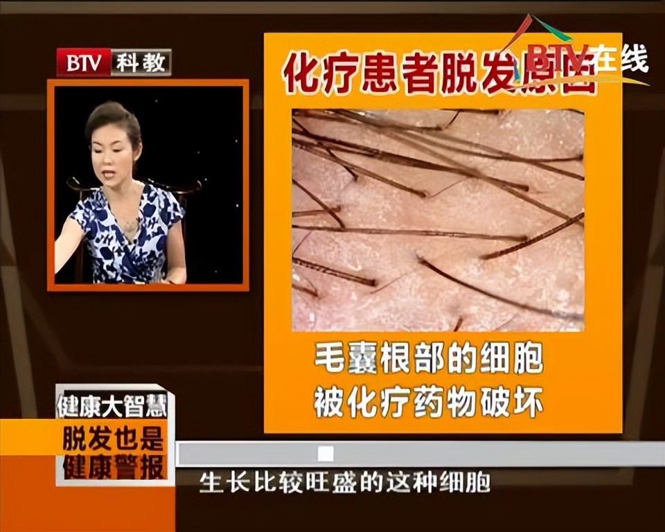 乳腺癌化疗脱发吗,三阴性乳腺癌化疗脱发