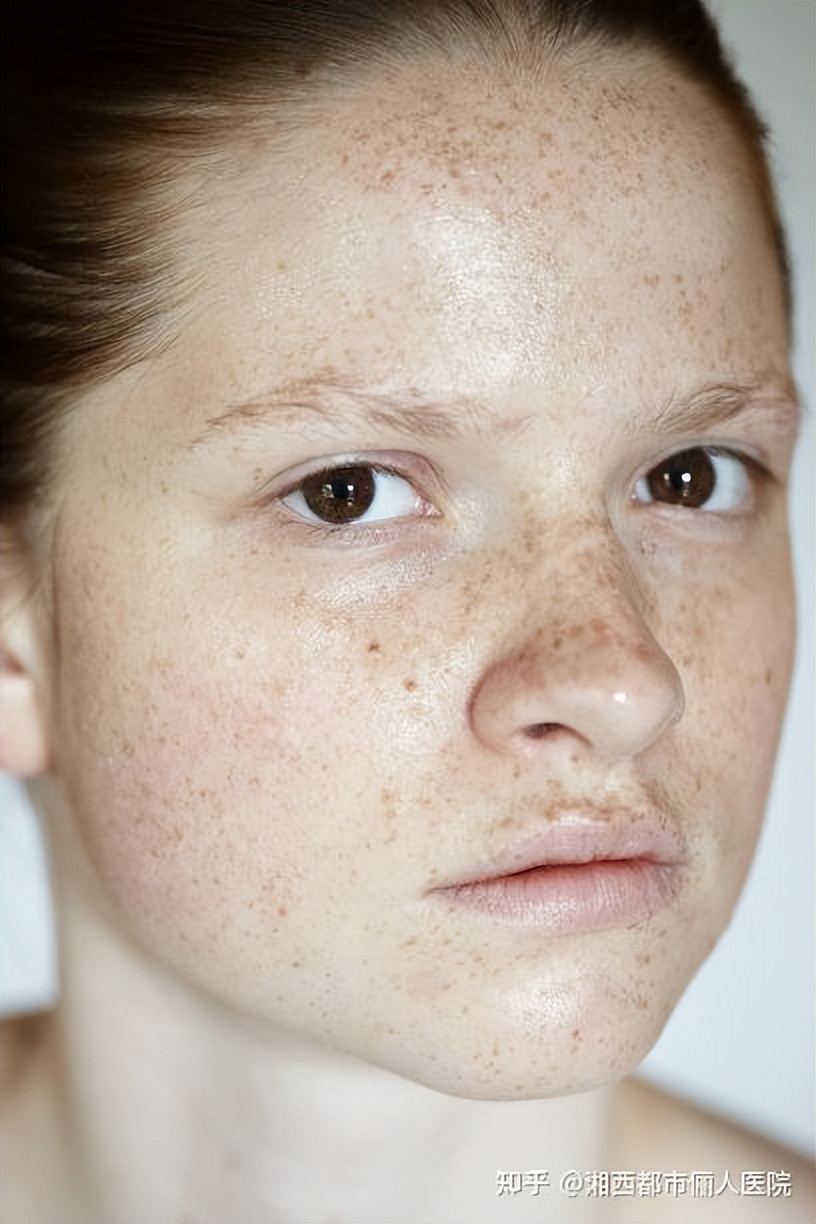 褐斑怎么去除才可以清除掉,褐斑怎样才能彻底的去掉