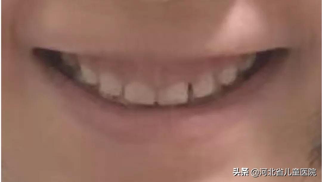 前牙龋坏修复,下前牙龋坏修复