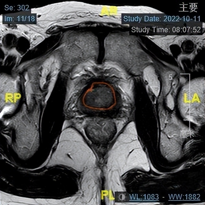 哈医大一院泌尿外科“新辅助”神奇疗法可缩小前列腺肿瘤为晚期前列腺癌治疗带来新方案