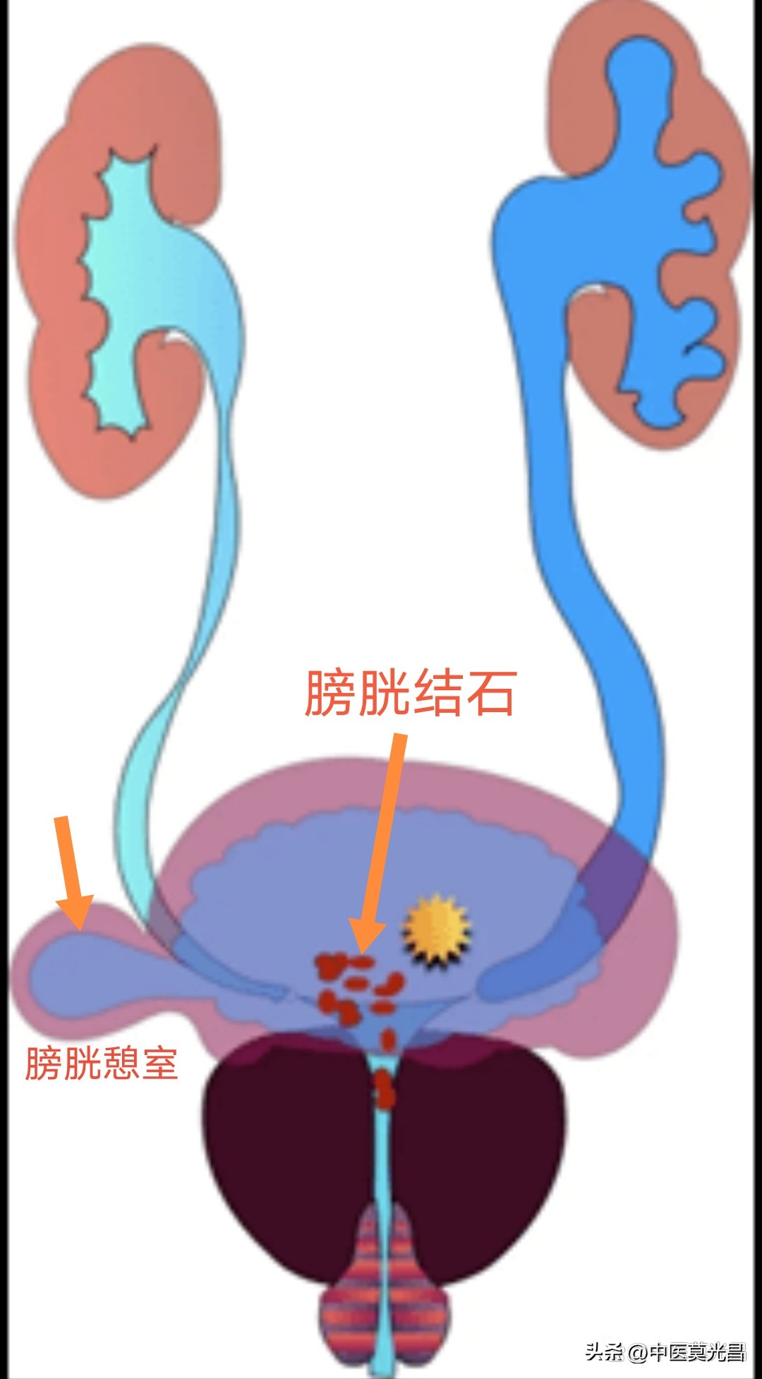 前列腺增生对膀胱结石有影响吗,前列腺增生膀胱炎食疗