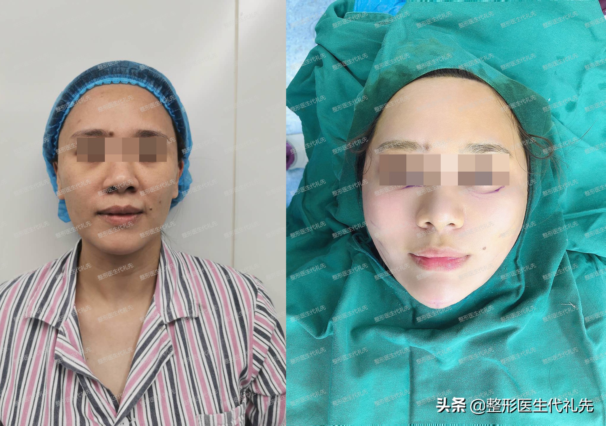 有法令纹最好的解决办法真实有效,法令纹严重最有效的办法