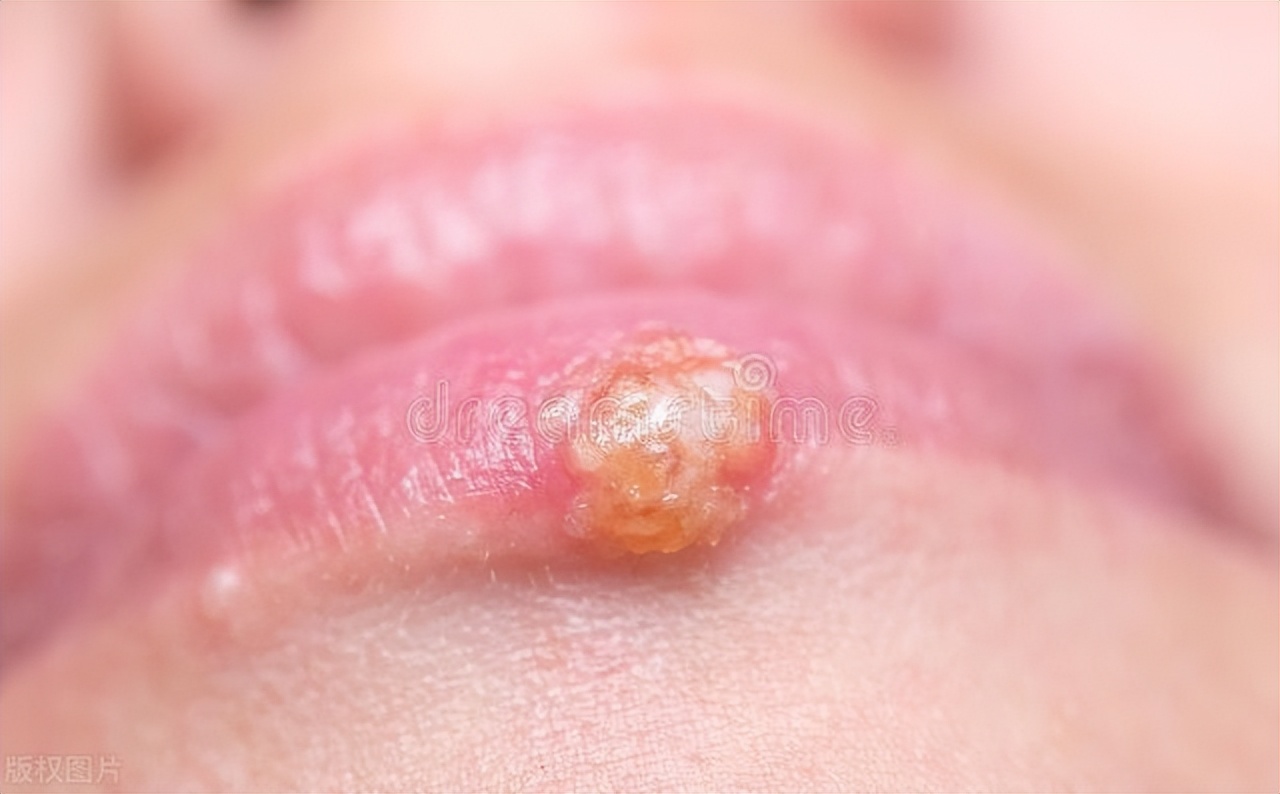 性病也有潜伏期？揭秘这5种常见性病的潜伏期，做好预防很重要