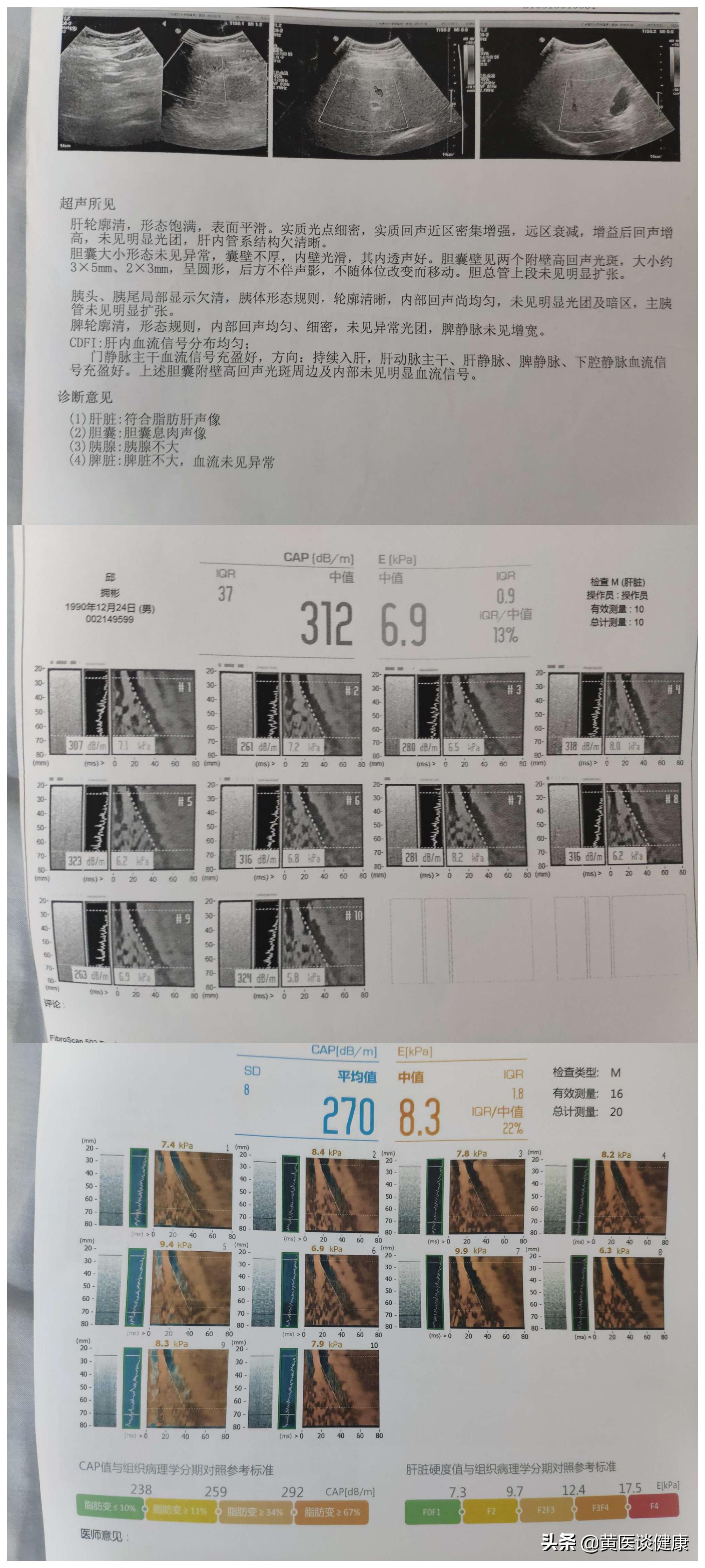 抗病毒三个月肝硬度反而升高,肝抗病毒后抗体升高