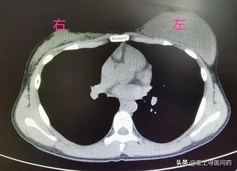 年轻女生胸部有肿瘤是啥原因,52岁女士胸部长个小瘤子越来越大