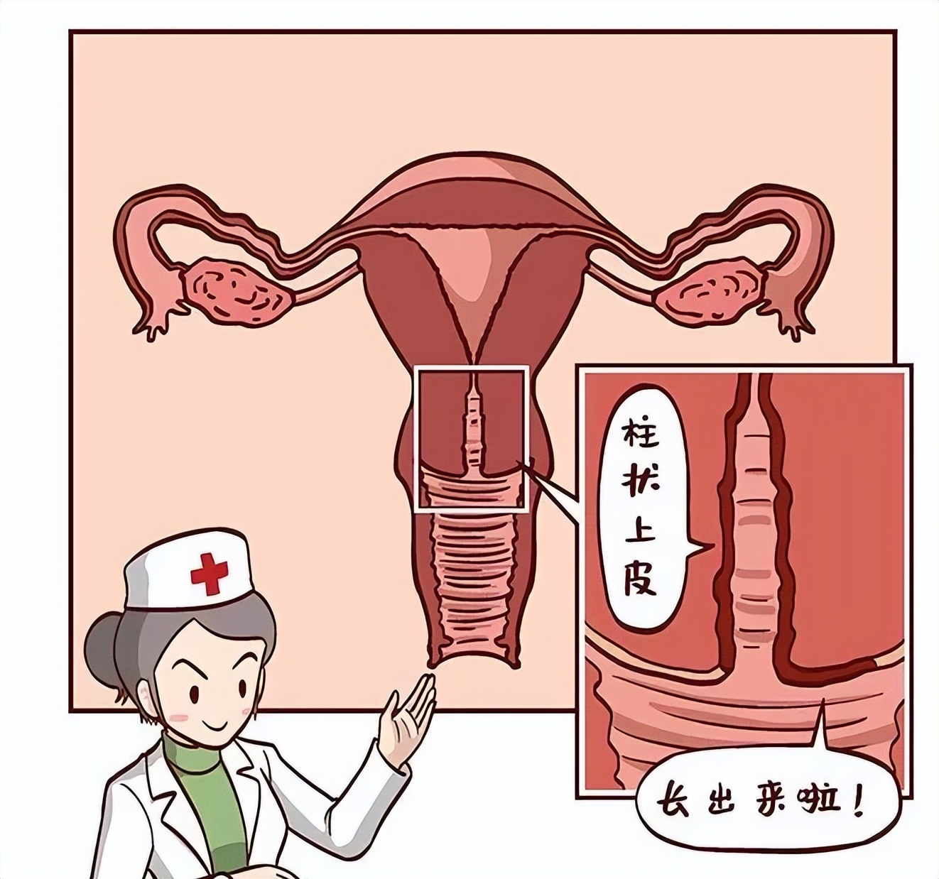 宫颈糜烂肥大囊肿会引起宫颈癌吗,六十岁宫颈糜烂中度会得宫颈癌吗