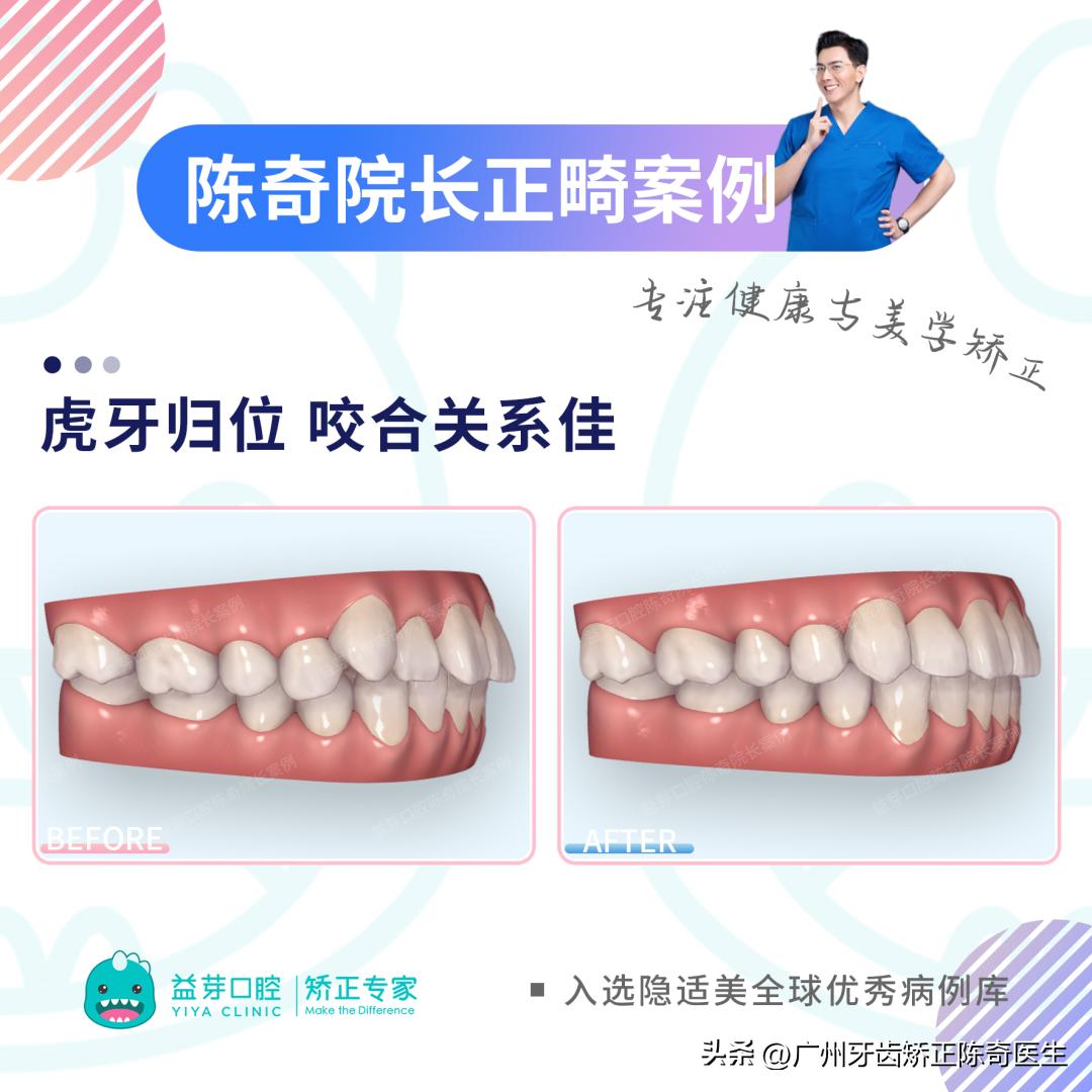 正畸治疗的基本矫治方法,正畸修复联合案例