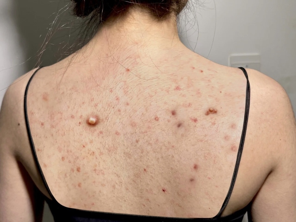 秘方去除顽固痘痘粉刺,背上痘痘痘印闭口快速祛除的妙招