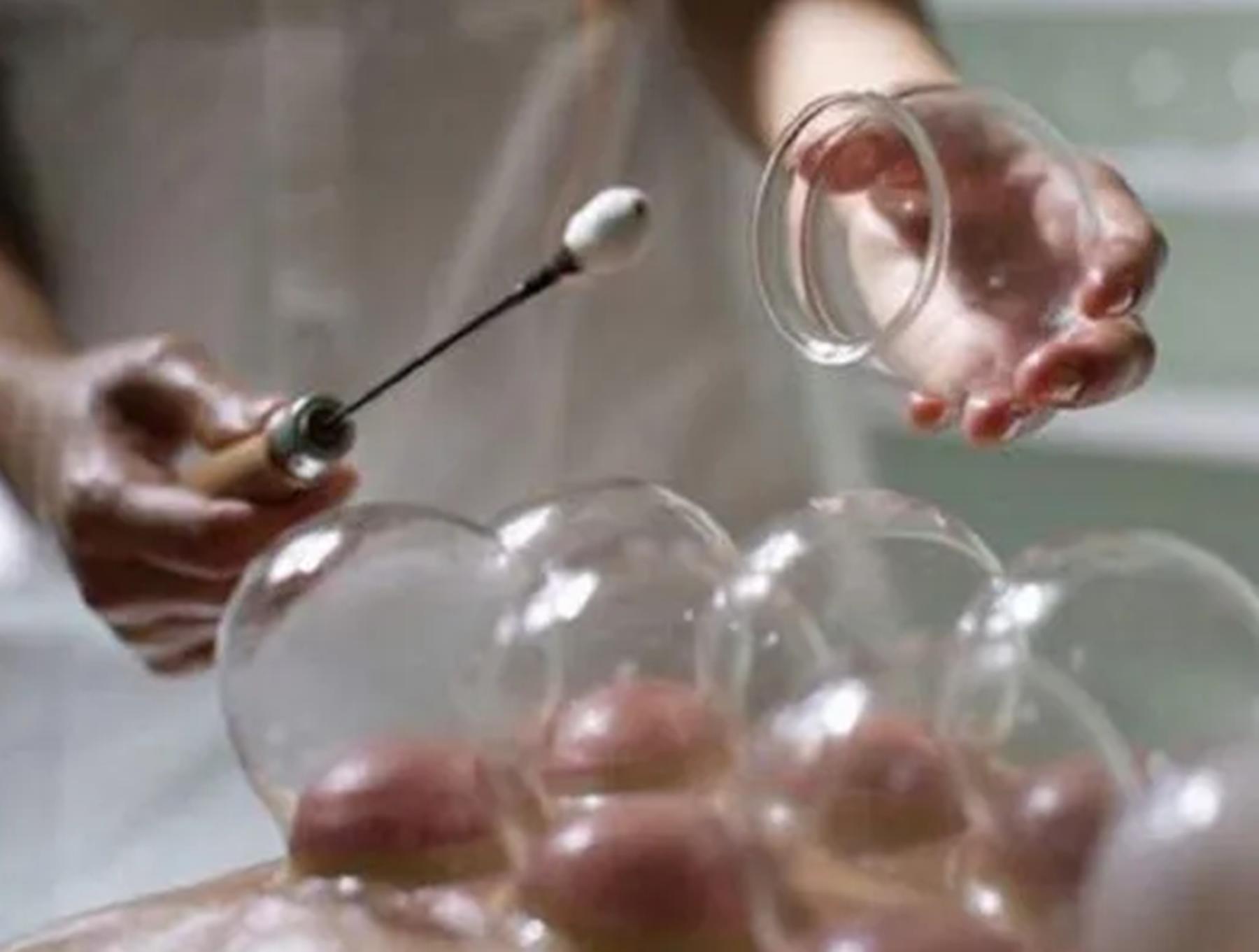 女子拔罐二度烧伤后续,女子拔火罐被烧伤后续