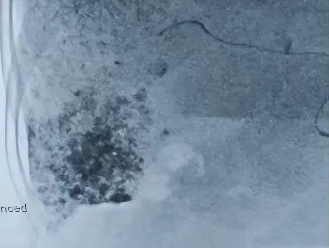 肝癌治疗出现奇迹,肝癌精准治疗