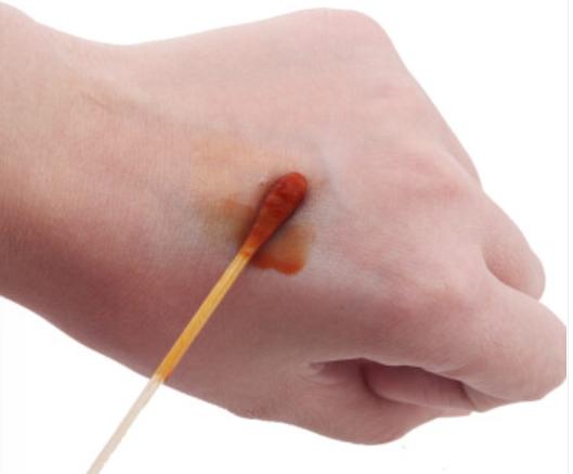 酒精、碘伏、碘酒、双氧水，我该用哪个消毒？