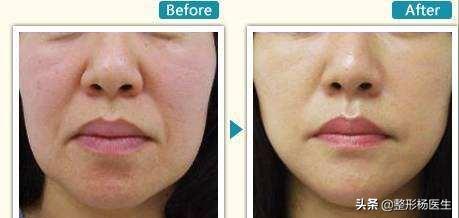 有法令纹特显老教你几招抚平细纹,法令纹这么显老得如何搞定