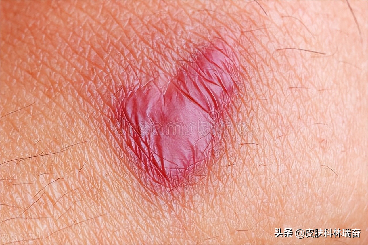 8种消除疤痕的自然方法,处理疤痕最好的方法