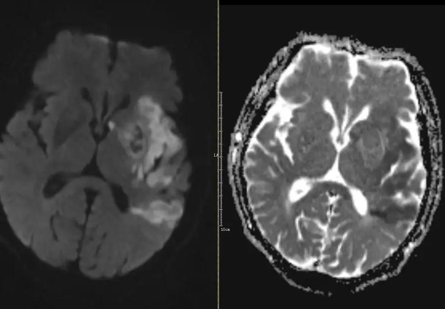 中风后遗症中医特效方,中风偏瘫后遗症秘方