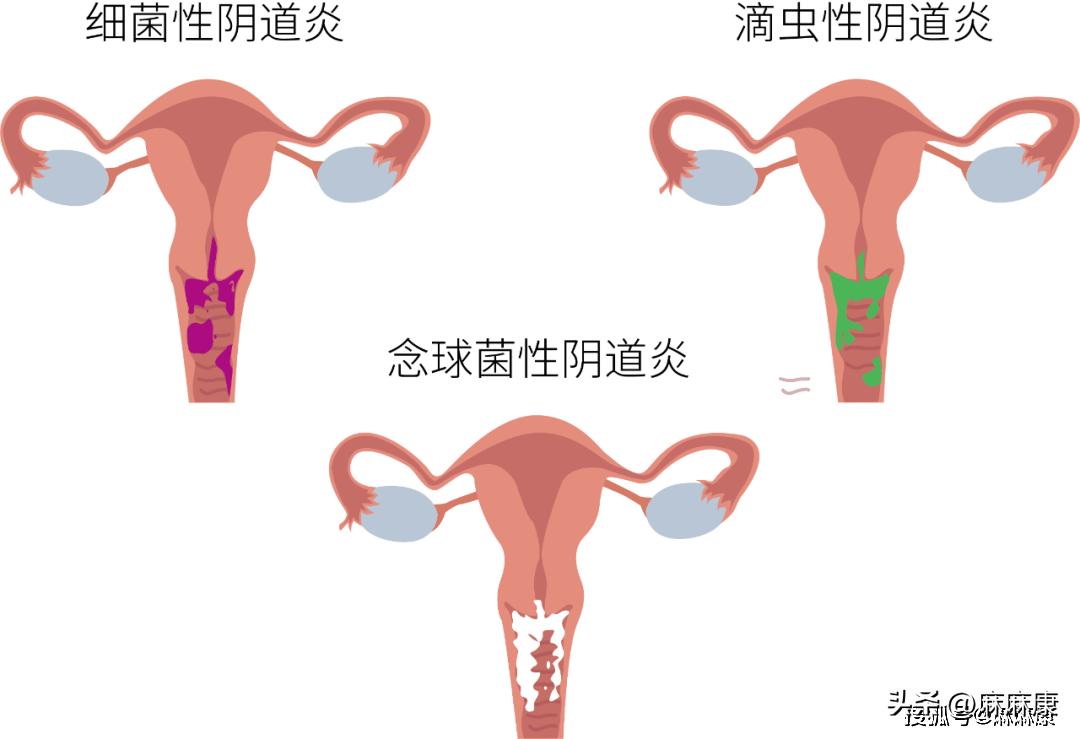 生育对身体的四大损伤！盆底肌常常被忽略