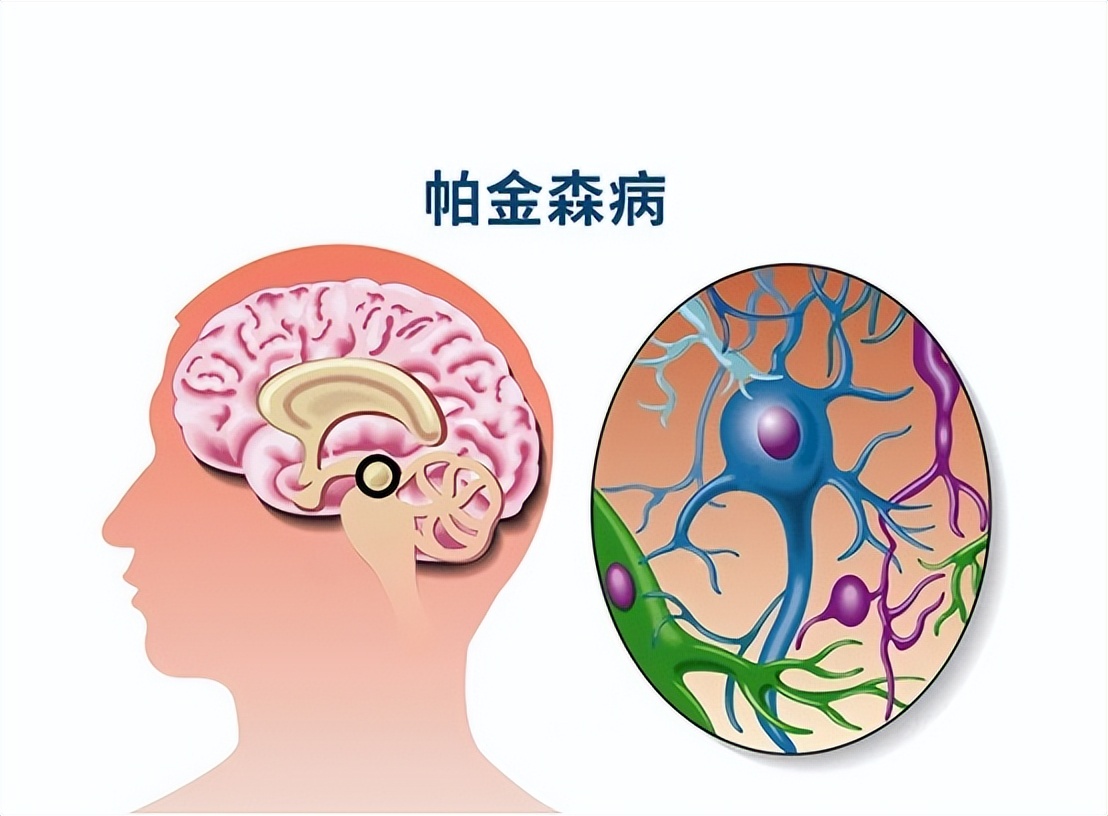 睡觉时腿抽筋是缺钙还是血脂高,睡觉时突然腿抽筋是缺钙导致的吗