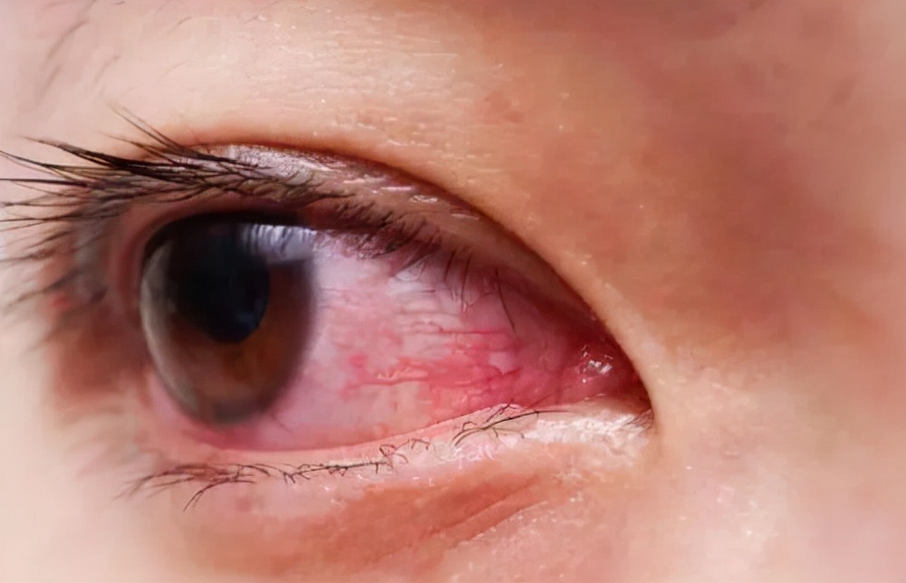 左眼皮上眼皮跳是什么预兆呢,左眼皮上眼皮跳是好运还是厄运