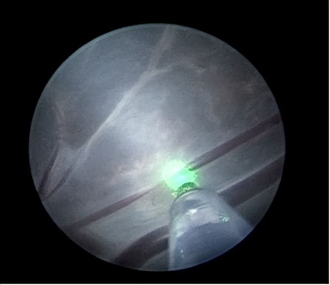 国内首例胎儿宫内手术,妇幼保健院首例阴式切除手术