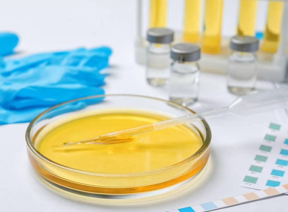 男人尿多警惕尿毒症,男人得了尿毒症会有什么表现