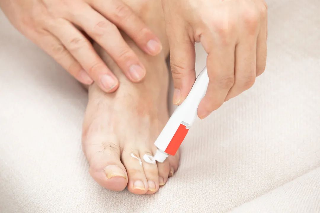 一到夏天脚气就反复发作,一到夏天就有脚气这个方法教给你