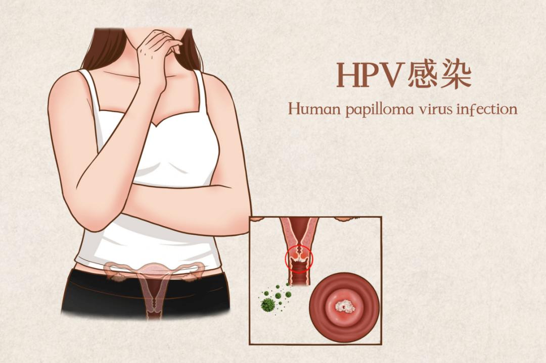 女性hpv感染多久才有可能转宫颈癌,80%女性会在一生中感染过hpv