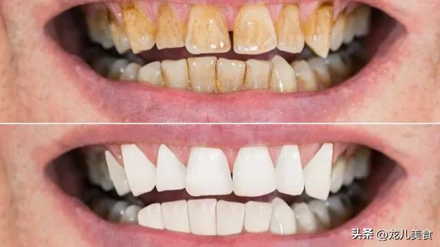 不经常刷牙牙齿黄洗牙管用吗,牙齿发黄用什么洗牙最好