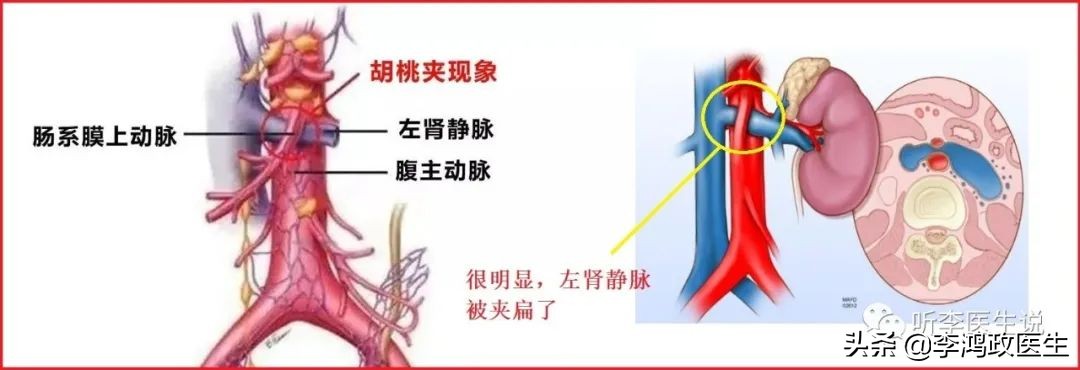 腰间盘突出有没有可能误诊,女子腰痛误诊腰椎间盘突出