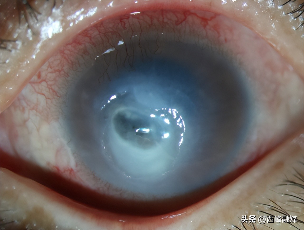 眼科发炎症状,眼睛疼是阳性的前期症状吗