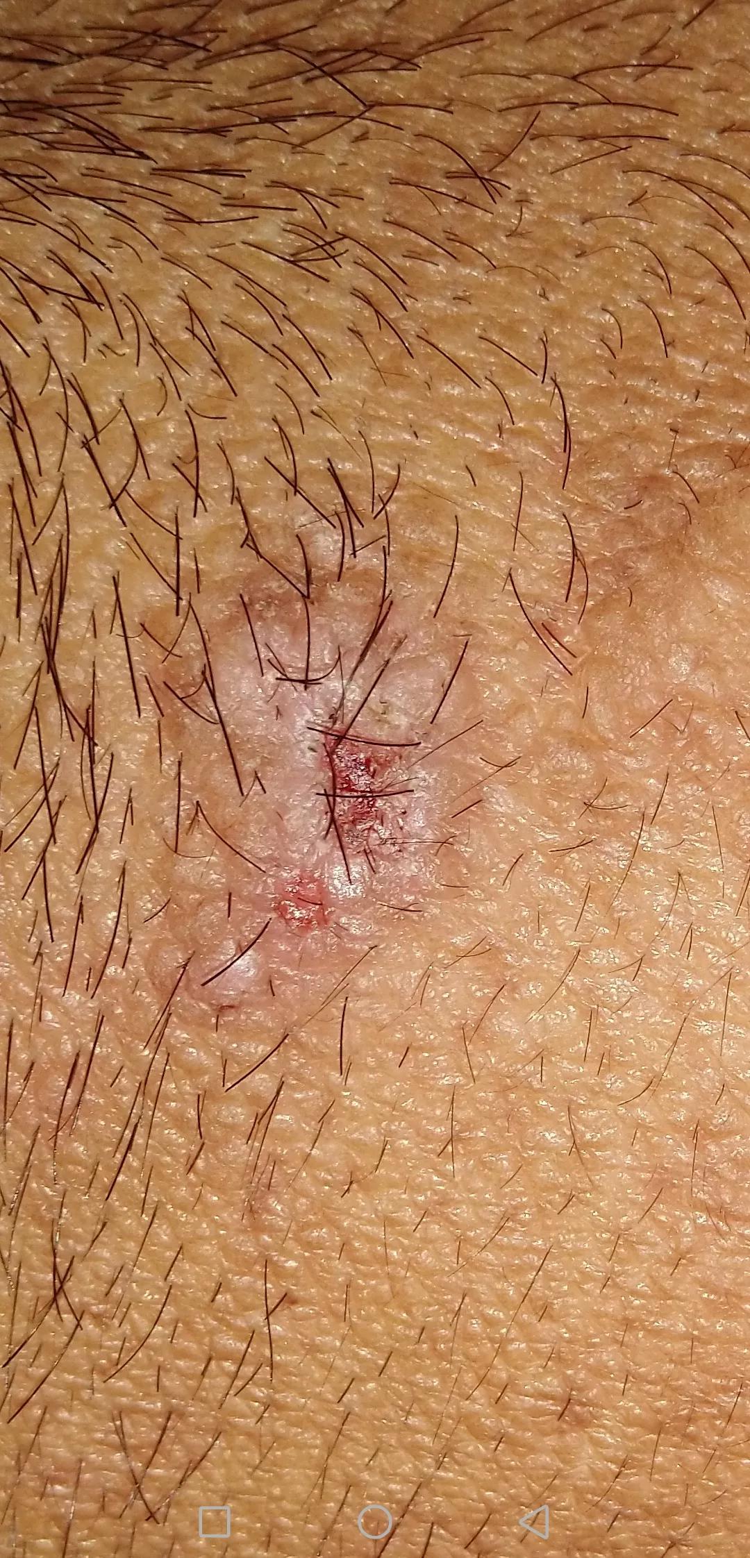 牛皮癣伴随一生是怎么样的体验,对抗牛皮癣一直在坚持