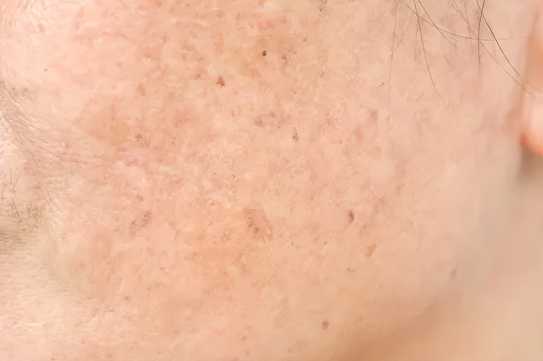 痘印和色斑什么东西最好遮,痘印色斑怎么最有效去除