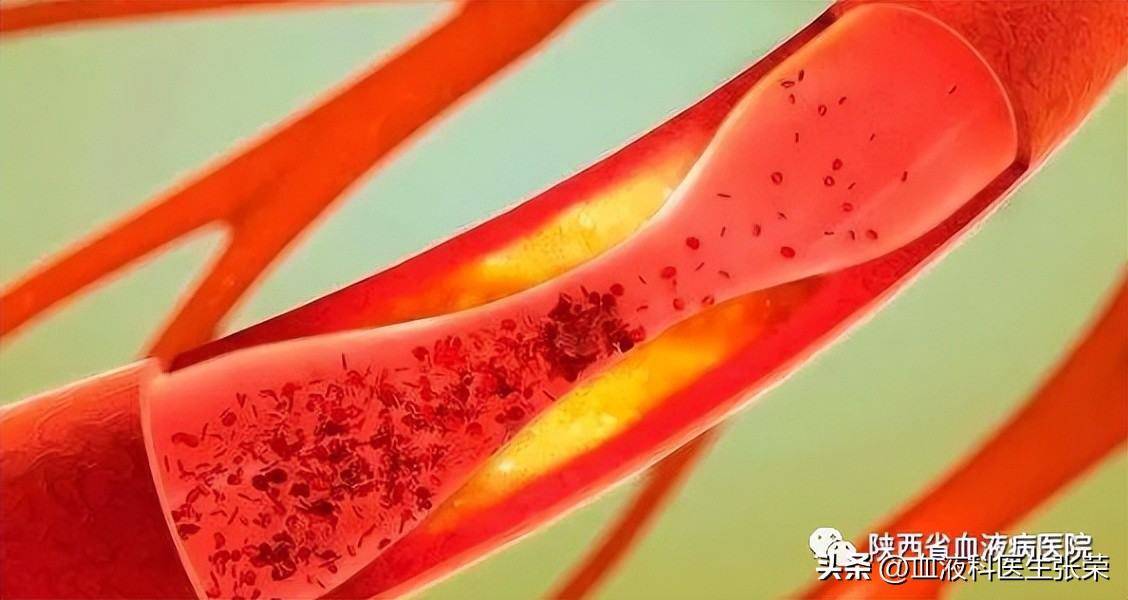 艾曲波帕能治好血小板减少症吗,血小板低吃艾曲波帕能根治不