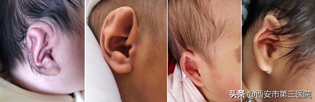 宝宝耳朵不对称怎么治,宝宝耳朵畸形左耳封闭能治好吗